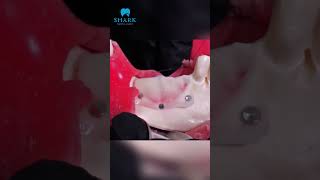 A Bone Graft case part 2