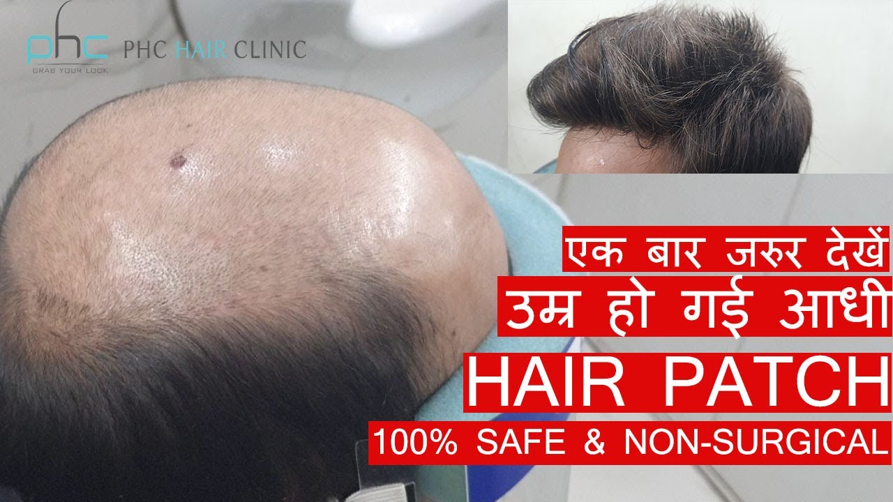 Hair Patch in Delhi | Hair Patch Price in Delhi | Hair Patch for Men by Planet of Hair Cloning