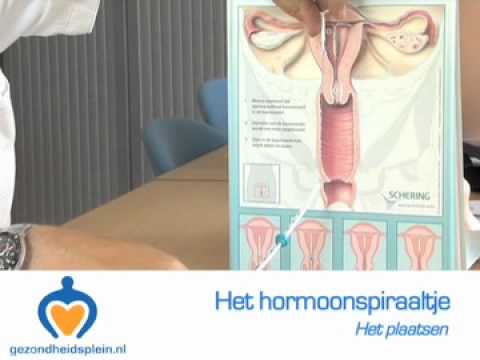 Hormoonspiraal - Wat is een hormoonspiraaltje en wat zijn de voor- en nadelen?