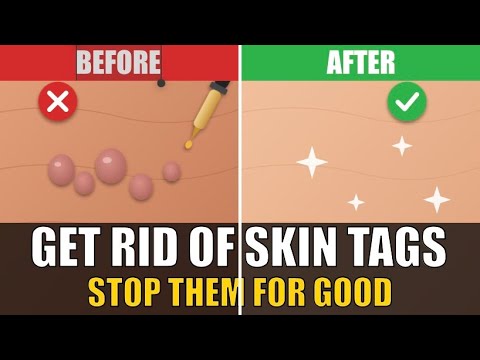 Compound Skin Tag How to Remove Skin Tags (& Help Prevent Them Coming Back) - YouTube