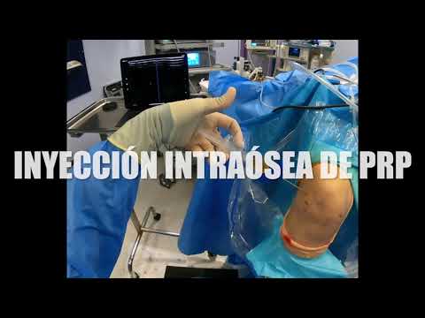 PRP INTRAÓSEO RODILLA