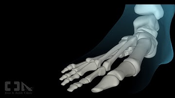 Minimally-Invasive Flexible Hammertoe Surgery