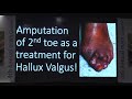 Foot amputations dr  rajiv shah olwa foot  ankle course