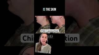 Chin Liposuction Immediately Before & After Results By Dr. Megan Dreveskracht