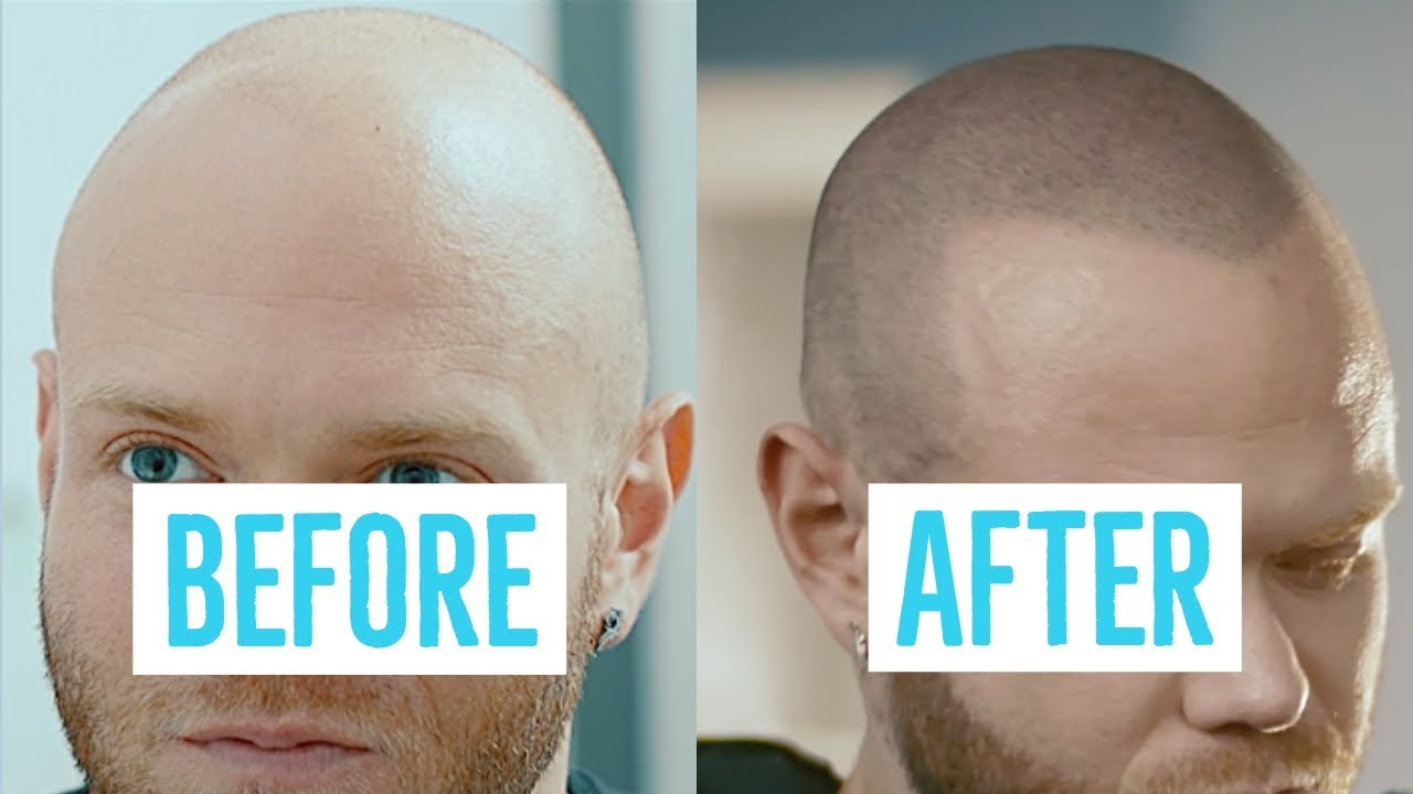 Hair loss solution before and after YouTube