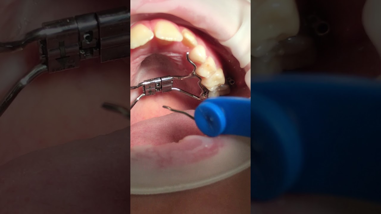 Dott.ssa M. Di Carmine. ATTIVAZIONE ESPANSORE PALATALE