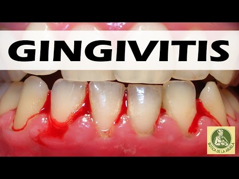 Gingivitis– Remedios caseros para la gingivitis - Como eliminar la gingivitis