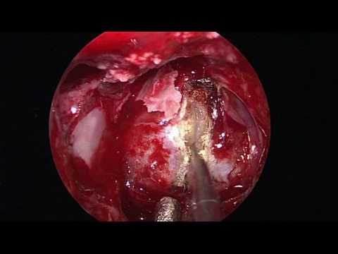 Эндоскопическое трансназальное удаление эндо-супра-латероселлярной аденомы гипофиза (18+)