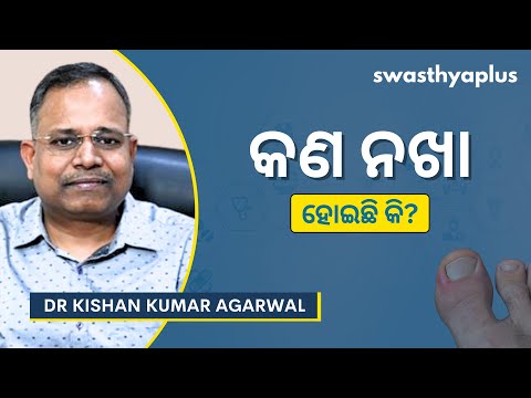 ନଖର ଯତ୍ନ କିପରି ନେବେ? | How to take care of your Nails? in Odia | Paronychia| Dr Kishan Kumar Agarwal