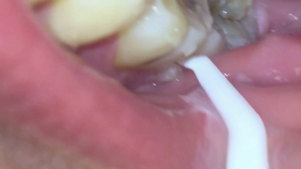 Tonsil Stone In Gums YouTube