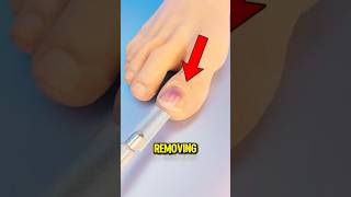 Why Runners Sometimes Lose Their Toenails It is More Common Than You Think 😱