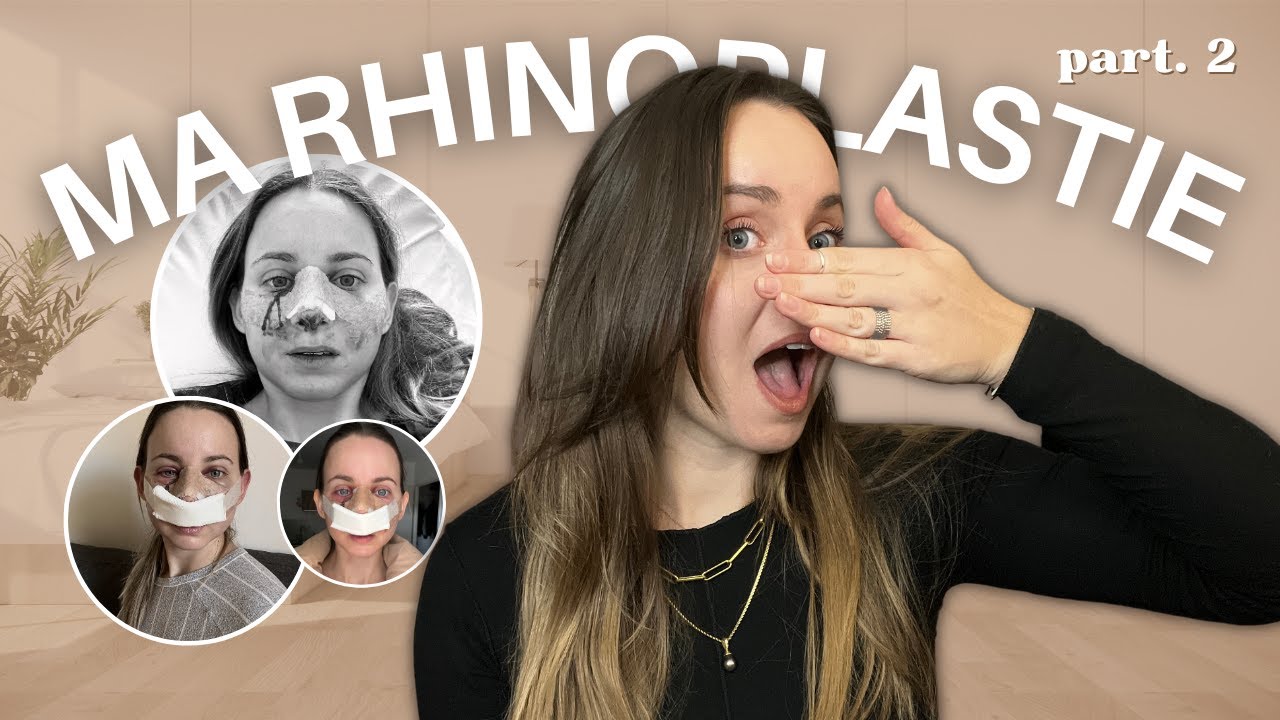 Tout sur ma RHINOPLASTIE - Partie 2 | Stellina