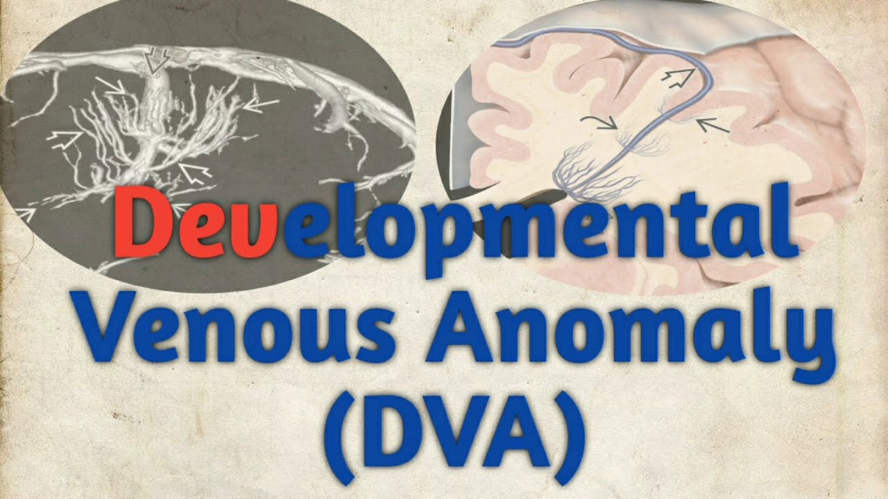 Case Report- Developmental Venous Anomaly (DVA)/CT BRAIN 🧠/ Radiology 2.0.......