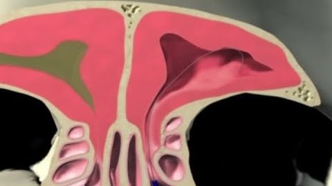 Đau đầu do viêm mũi xoang