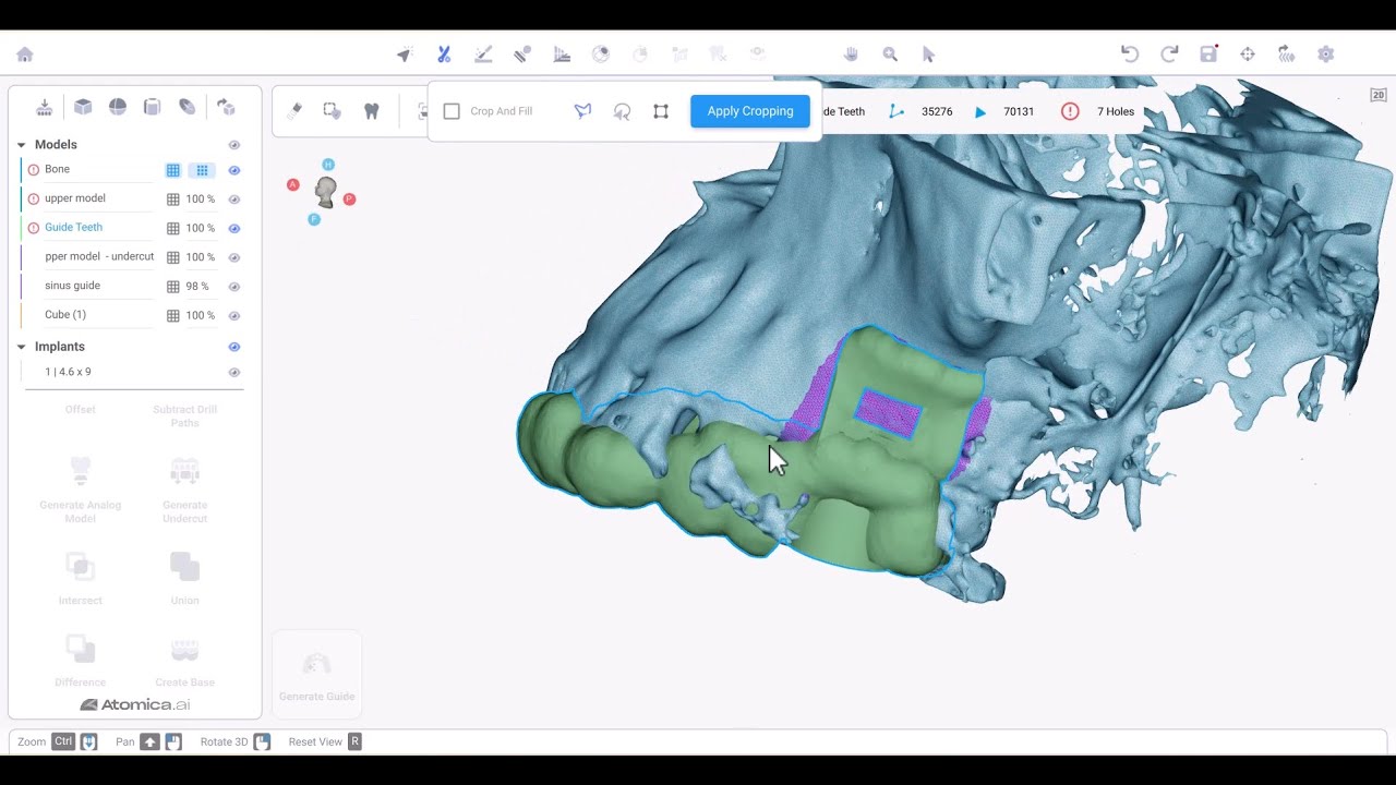 [Go Guided With Atomica] Advanced Sinus Lifting (Case Study) - YouTube
