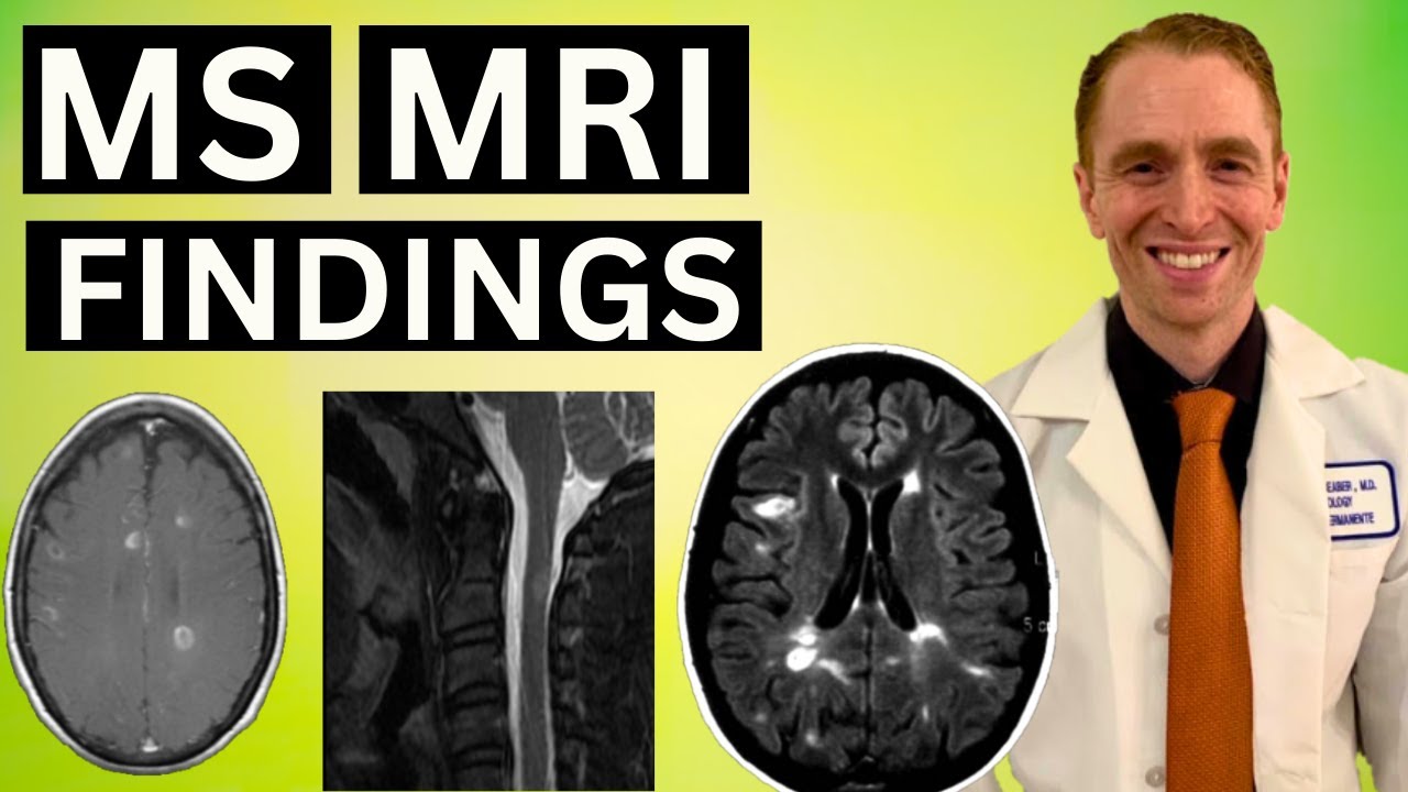 Результаты МРТ-исследования при рассеянном склерозе, разъясненные неврологом.