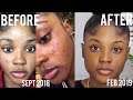 SKIN UPDATE Q&A! CLEARED MY SKIN IN 5 MONTHS?| KAISERCOBY