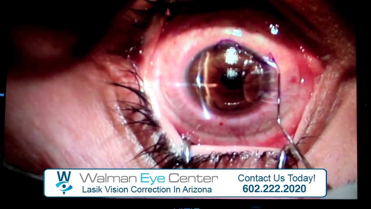 Lasik Eye Center >> Lasik Vision Correction at Walman Eye Center | Phoenix, Arizona - YouTube Lasik Eye Center >> Lasik Vision Correction at Walman Eye Center | Phoenix, Arizona - YouTube