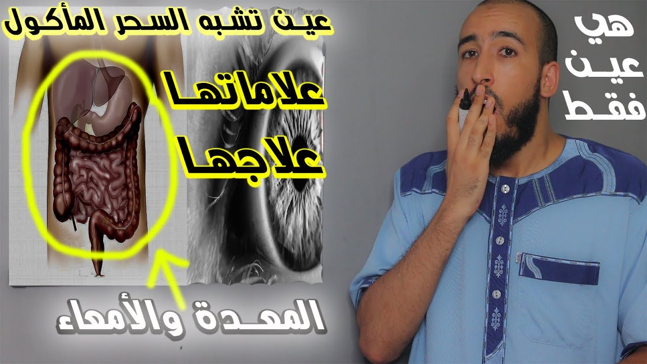ما هي العين المأكولة والتي تشبه السحر المأكول؟ وما هي علاماتها وأعراضها؟ وما هو علاجها؟
