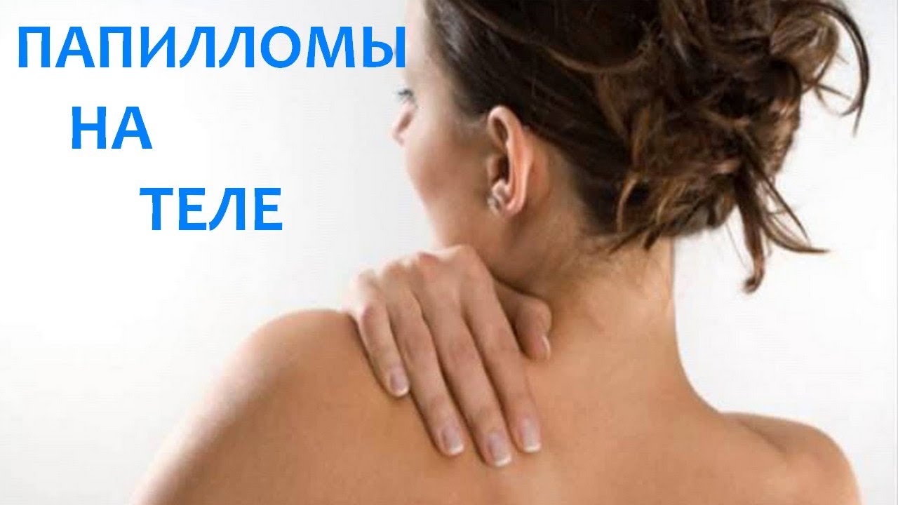 Почему на теле человека появляются папилломы - YouTube