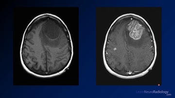 Neuroradiology unknown case 1