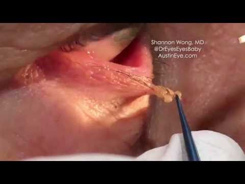 Video: Papilloma On The Eyelid: Photo, Removal, Causes Of Appearance