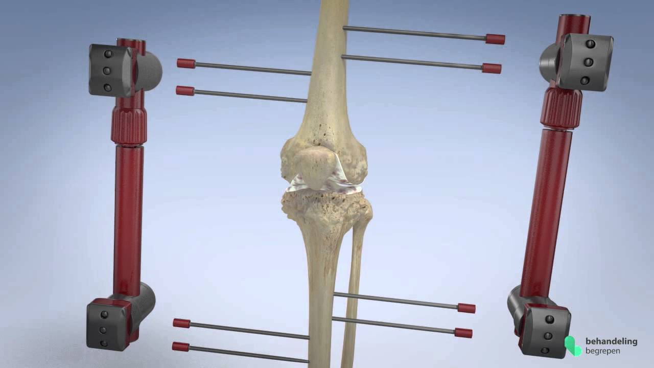PREVIEW Knie distractie - Medische animatie