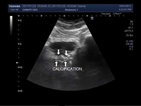 prostate calcification ultrasound