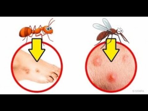 Vidéo: Différence Entre L'urticaire Et Les Piqûres D'insectes