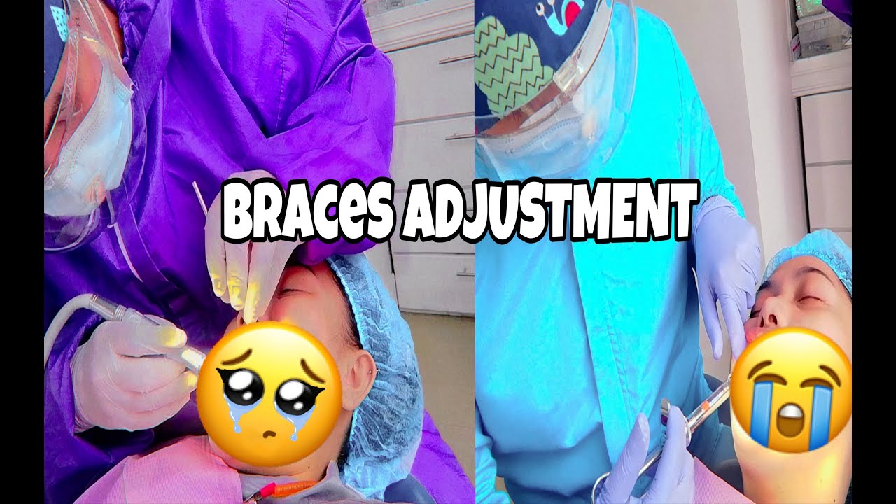 Braces Adjustment (Bunot 😳) YouTube