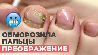 видео: Обмороженные пальцы | Проблемные ногти | Исправляем картинка: Обмороженные пальцы | Проблемные ногти | Исправляем