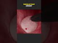 Tonsillectomy Surgery To RemoveTonsils (3D Animation)#tonsillectomy #tonsillectomysurgery
