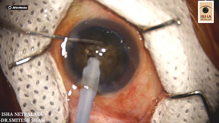 " Hard Brown Cataract done with Venturi system- By...