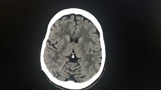 Interesting case No 31 - CT Brain