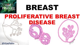 DISEASES OF BREAST Part 2: PROLIFERATIVE BREAST DISEASE