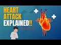 Heart Attack – How it Happens & How to Prevent It