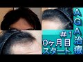 ＃1　AGA治療スタート！フィナステリドとミノキシジルを使っていきます！