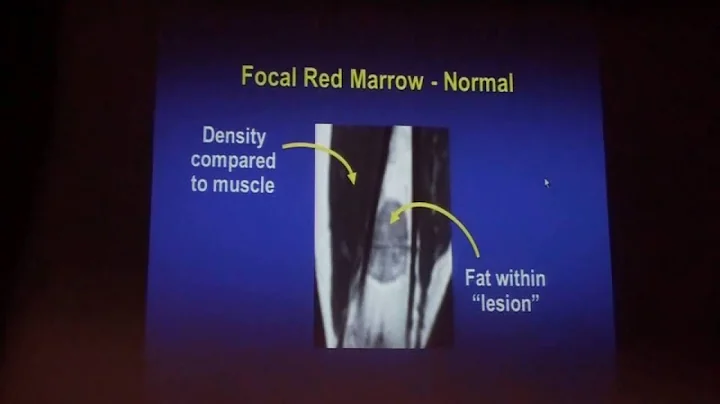 Bone Marrow Abnormalities on MRI An Approach to An...