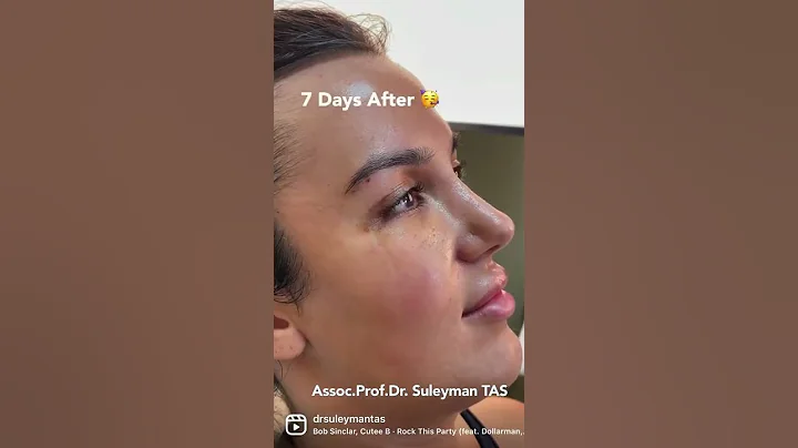 FoxEyes Surgery | Before And After | Dr. TAS - DayDayNews