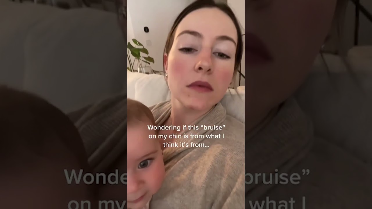 Bruise on my chin…