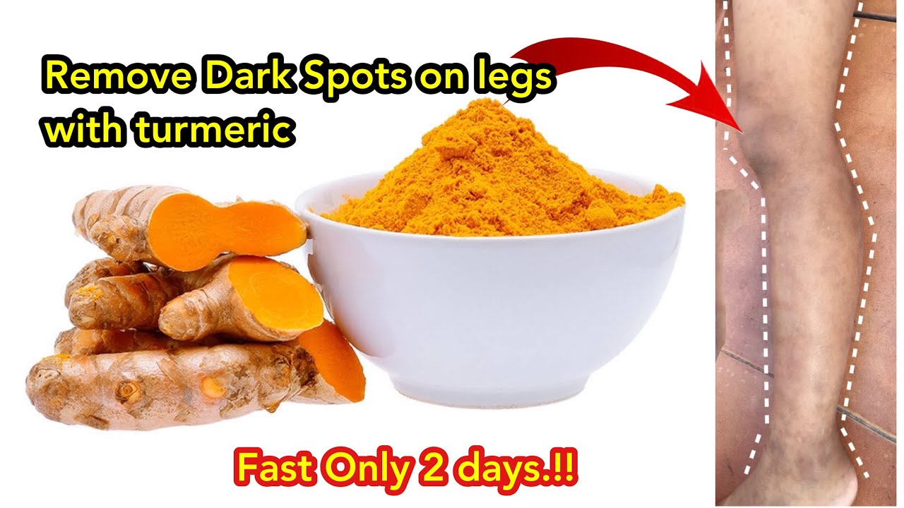 Remove Dark Spots on legs, Mosquito Bites, Scar,Hyperpigmentation On