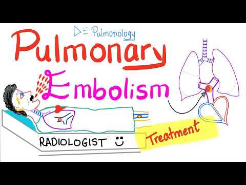 Pulmonary Embolism Management | Thromboembolism | Pulmonology