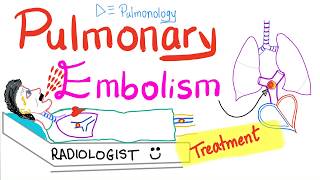 Pulmonary Embolism Treatment  Thromboembolism  Pulmonology Playlist