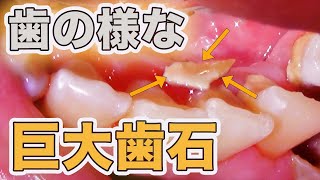 歯の様な巨大歯石