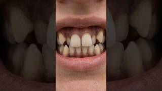 Crowded Teeth Correction 😱 Braces Gradually Align