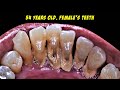 REMOVE CALCULUS | SCALING TARTAR | Dentist | Dokter Gigi Tri Putra