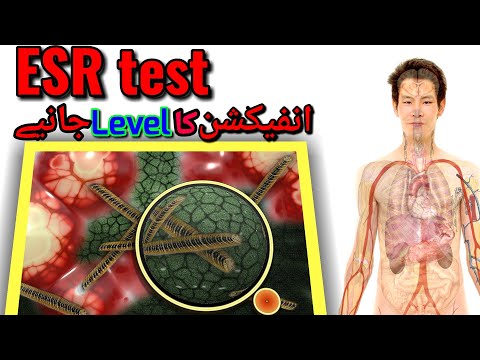 ESR test,value,infection disease,symptoms|urdu/hindi