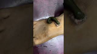 Leech Therapy ??|  | Dr ak Jilani |cuppingtherapyshorts