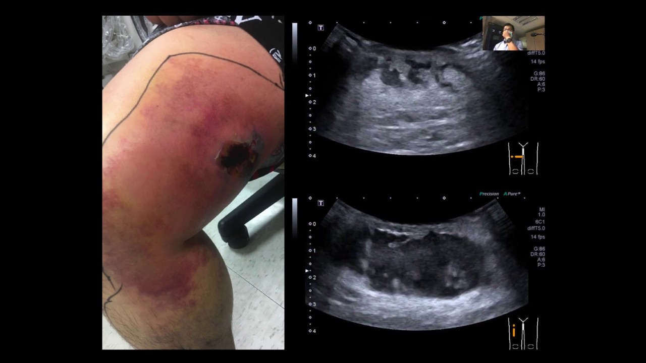 軟組織及骨骼肌肉超音波在急診的應用 Pocus Academy