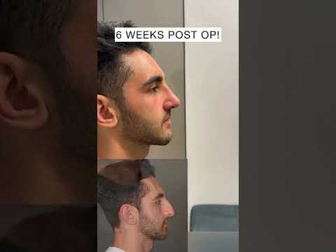 Video thumbnail: Trust the Process: Male Rhinoplasty Reveal 👃✨ #rhinoplasty #plasticsurgery